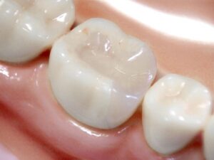 白い歯　治療方法